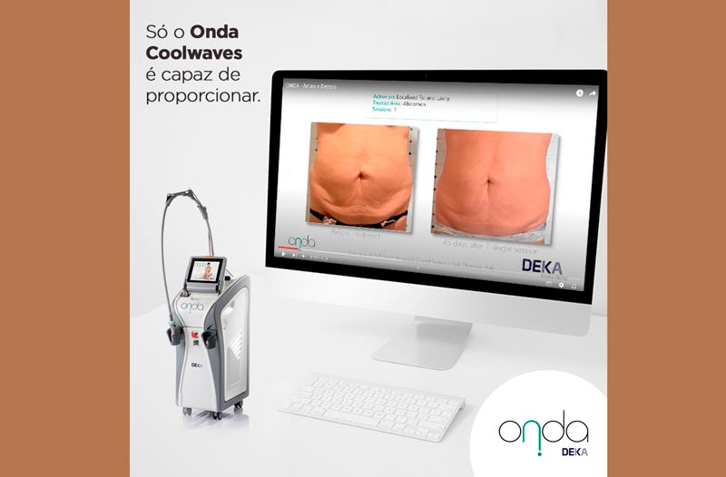 coolsculpt-maquina